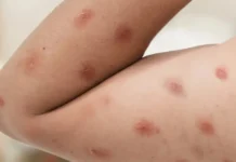 Sobe para 140 número de casos confirmados de Mpox no país, em 2026